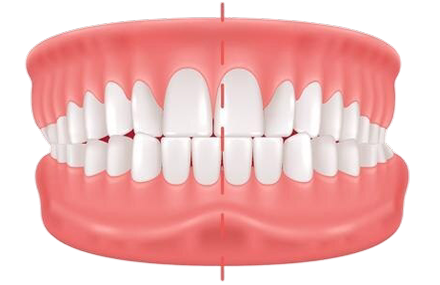 Crossbite Image  icon