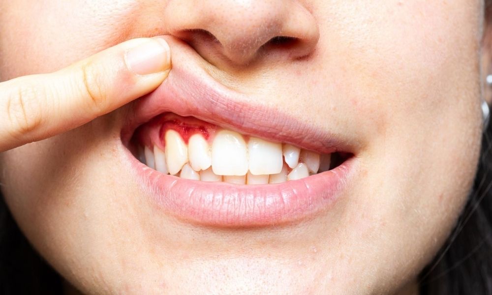 Treatment for gum disease Image